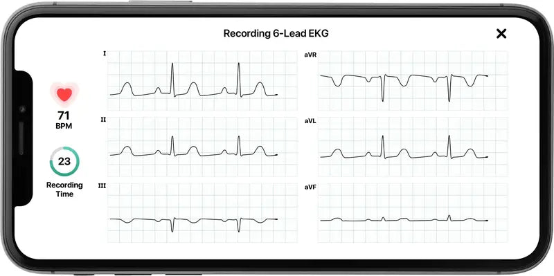 KardiaMobile 6L Personal EKG Monitor – FDA-Cleared 6-Lead Heart Rhythm Tracker Compatible with Most Smartphones